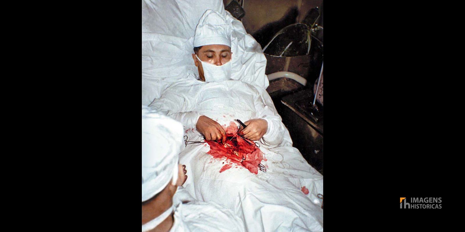 O médico soviético Leonid Rogozov, de 27 anos, realiza uma cirurgia em si mesmo para remover seu apêndice inflamado na estação Novolazarevskaya, na Antártica, em 1961. Sendo o único médico na expedição, ele não teve outra escolha para sobreviver.