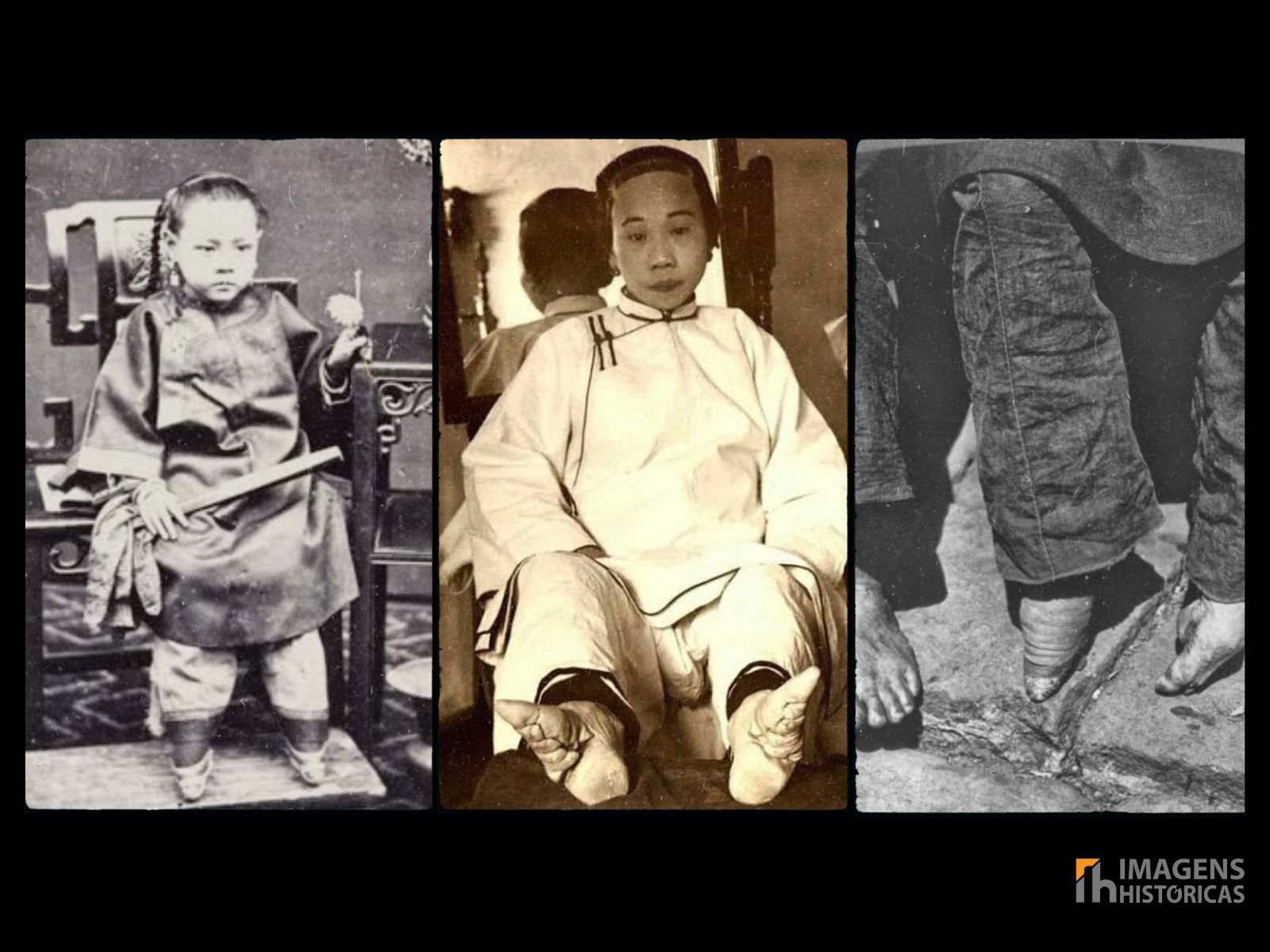 Os pés de lótus, foi uma prática tradicional na China por cerca de mil anos. Começou durante a Dinastia Song (960-1279) e perdurou até o início do século XX. Esta prática foi principalmente um símbolo de beleza e status social para as mulheres, mas também causou deformações permanentes e muito sofrimento. Os pés de lótus, foi uma prática tradicional na China por cerca de mil anos. Começou durante a Dinastia Song (960-1279) e perdurou até o início do século XX. Esta prática foi principalmente um símbolo de beleza e status social para as mulheres, mas também causou deformações permanentes e muito sofrimento.