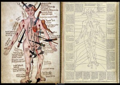 “Wound Man” (homem ferido, em português), é uma ilustração notável que apareceu pela primeira vez no livro Fasciculus Medicinae, publicado em Veneza em 1492. O compêndio médico da Renascença é conhecido por integrar imagens detalhadas e textos médicos para facilitar a prática clínica. A figura do Wound Man simboliza o avanço na educação médica e reflete o esforço da época em entender melhor as condições de saúde e os métodos de tratamento.