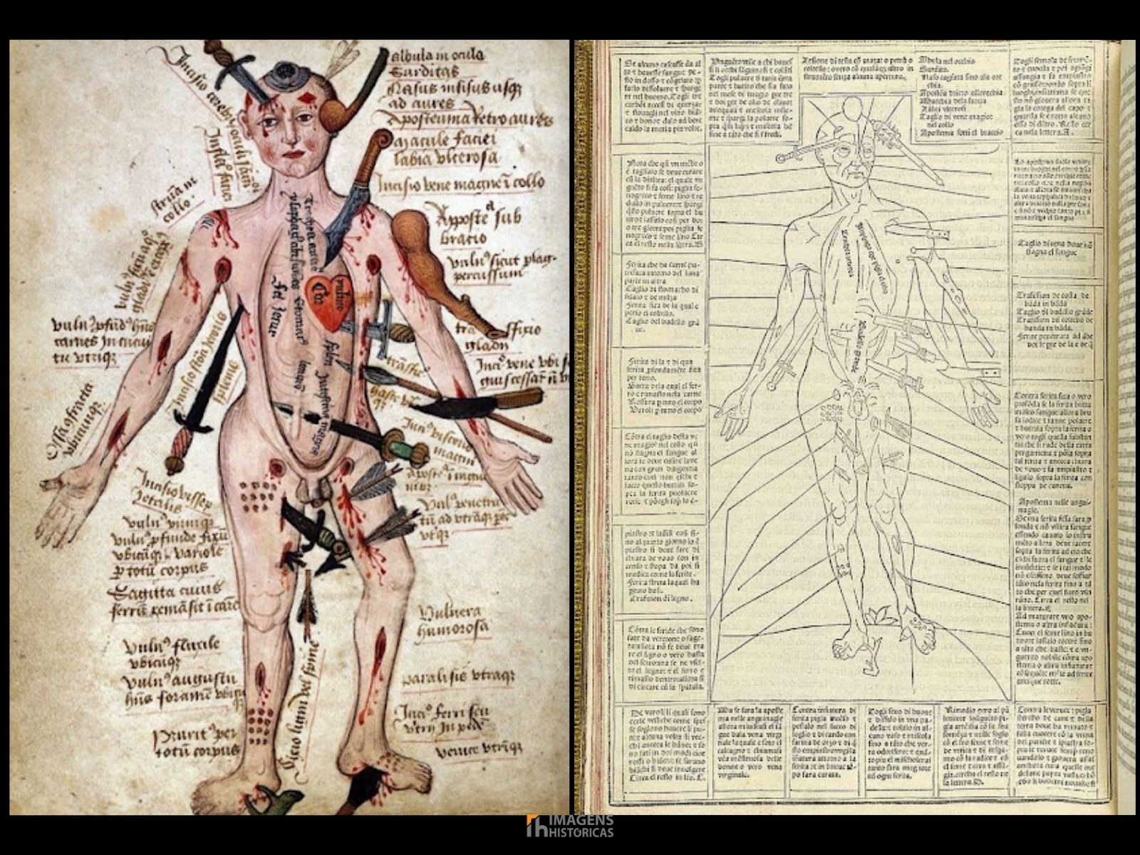 “Wound Man” (homem ferido, em português), é uma ilustração notável que apareceu pela primeira vez no livro Fasciculus Medicinae, publicado em Veneza em 1492. O compêndio médico da Renascença é conhecido por integrar imagens detalhadas e textos médicos para facilitar a prática clínica. A figura do Wound Man simboliza o avanço na educação médica e reflete o esforço da época em entender melhor as condições de saúde e os métodos de tratamento. “Wound Man” (homem ferido, em português), é uma ilustração notável que apareceu pela primeira vez no livro Fasciculus Medicinae, publicado em Veneza em 1492. O compêndio médico da Renascença é conhecido por integrar imagens detalhadas e textos médicos para facilitar a prática clínica. A figura do Wound Man simboliza o avanço na educação médica e reflete o esforço da época em entender melhor as condições de saúde e os métodos de tratamento.